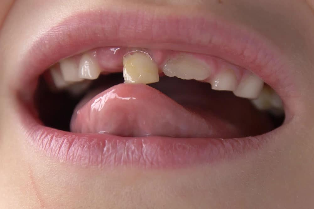 Treatment for mobile or loose teeth