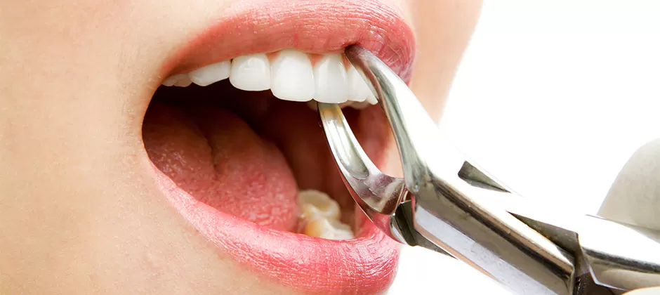 Tooth extraction including wisdom teeth