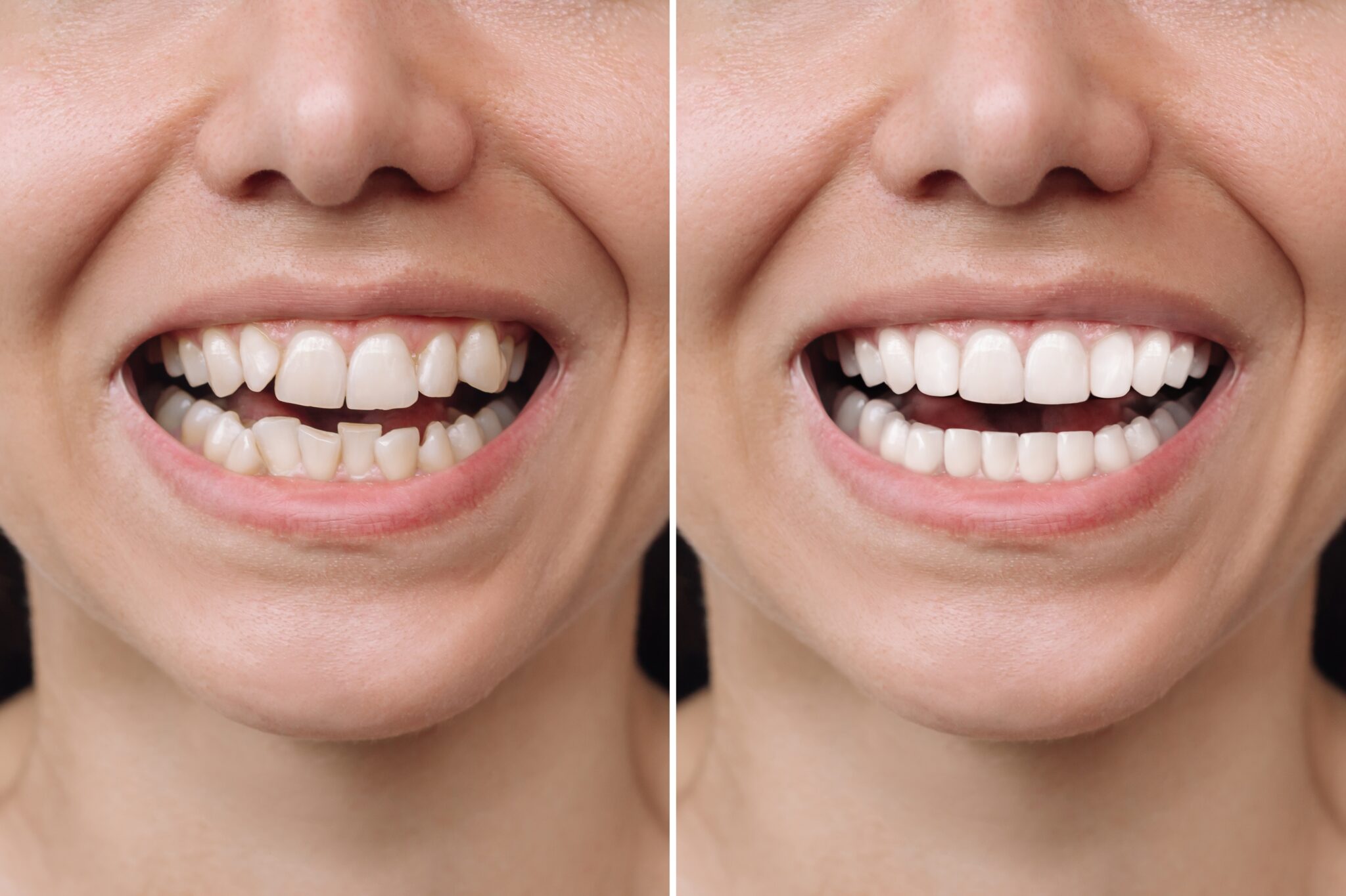 Porcelain and composite dental veneers
