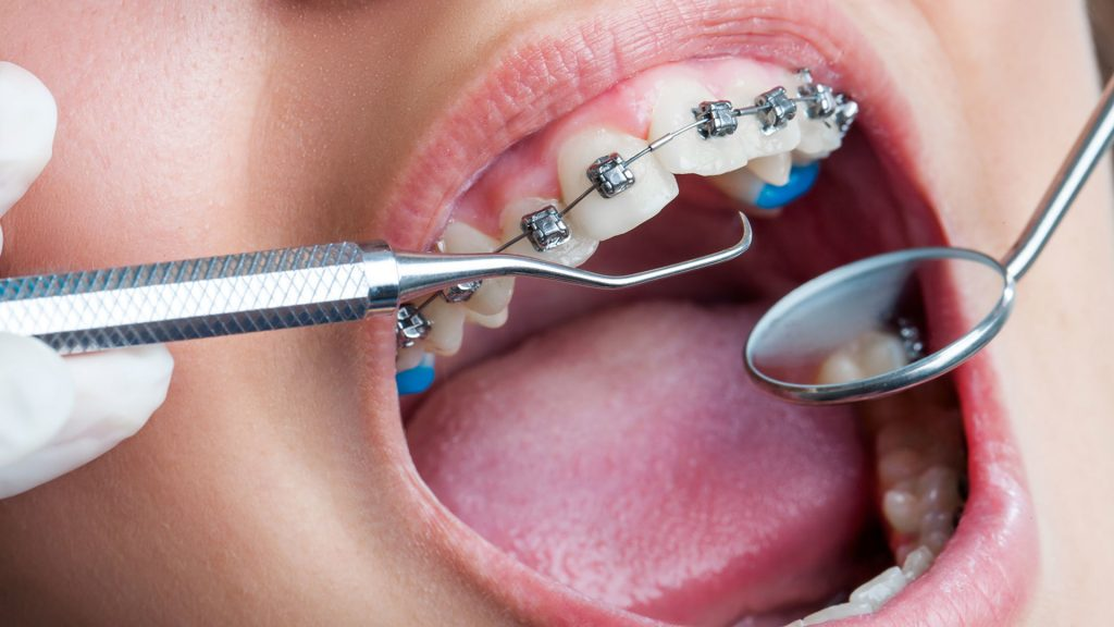 Orthodontic treatment with metal or ceramic braces
