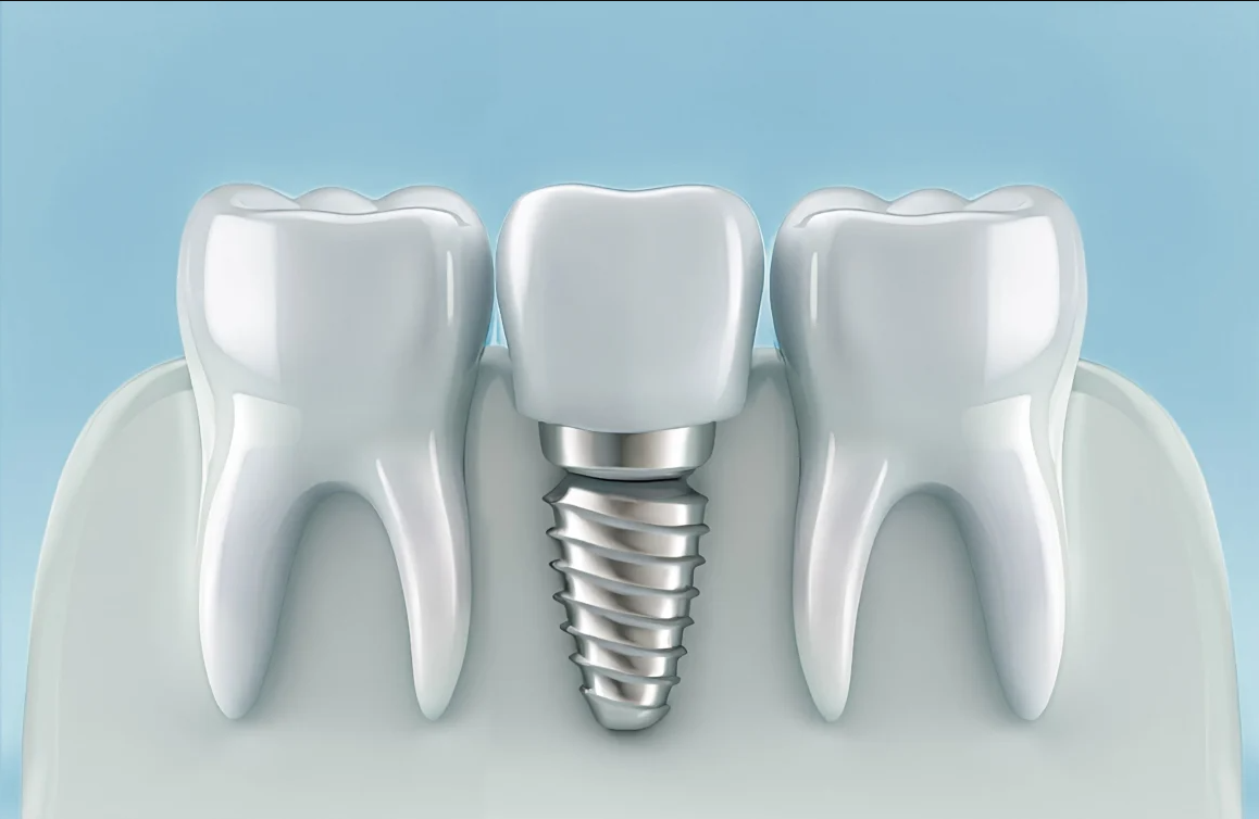 Dental Implants at Doaba Dental Clinic