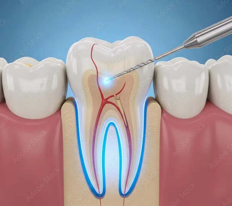 Root Canal Treatment with digital X-ray guidance