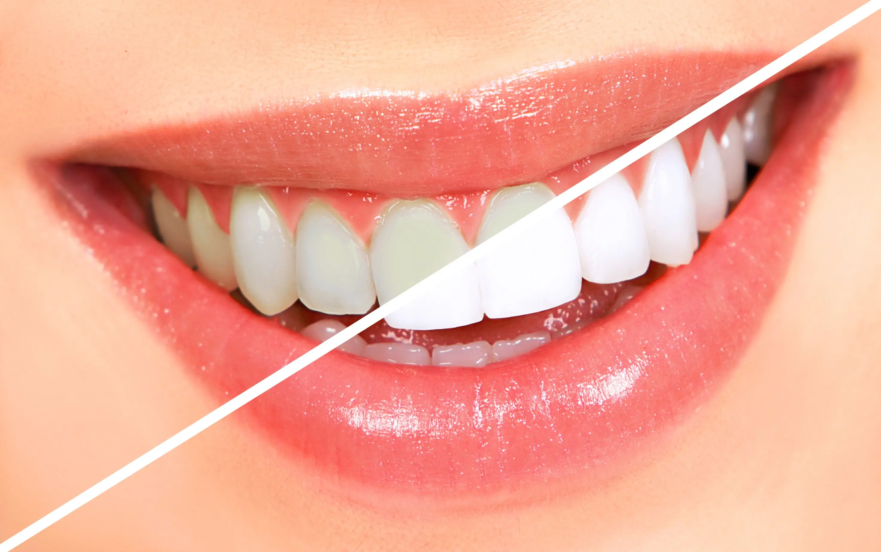 Teeth cleaning, scaling and oral prophylaxis