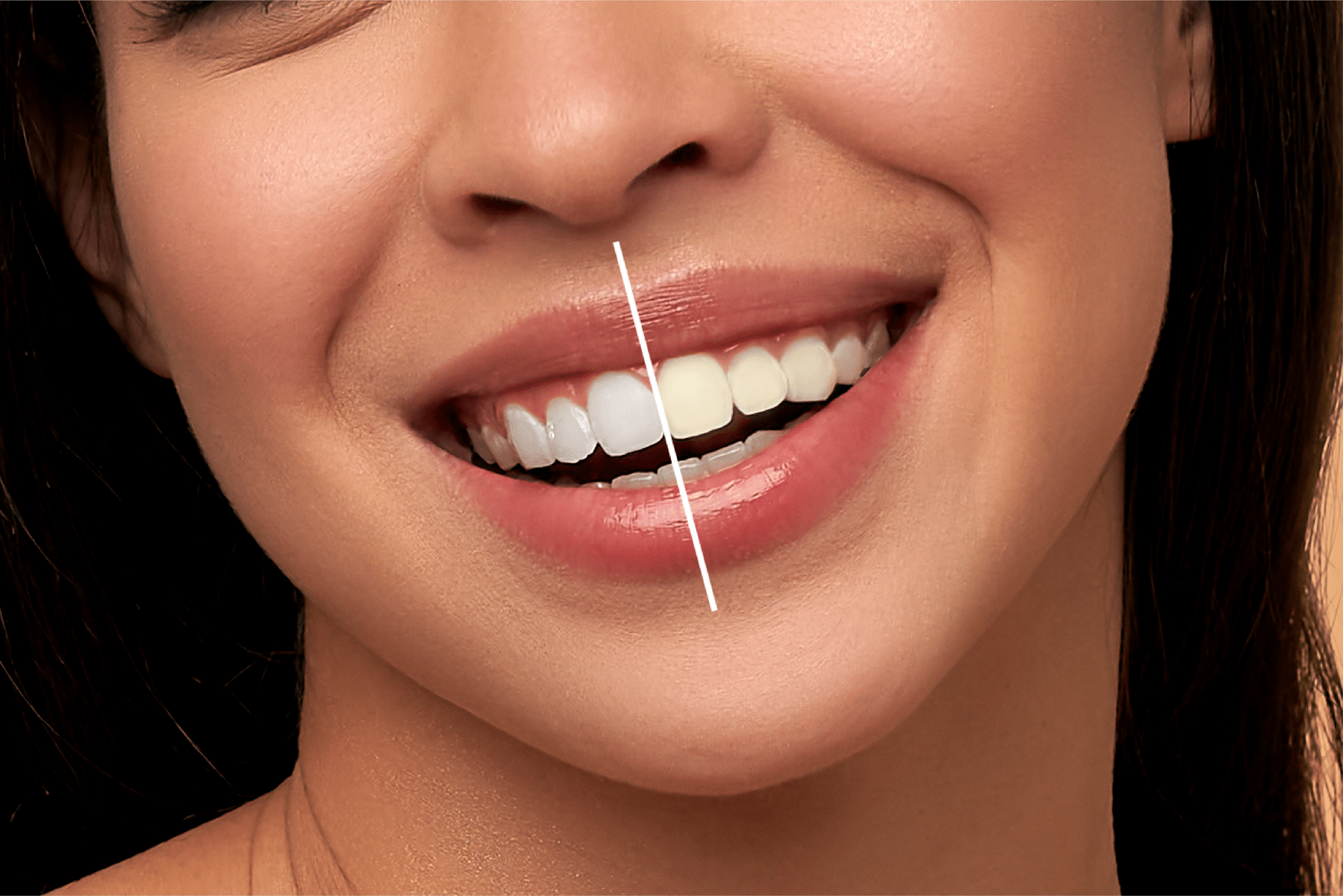 Teeth whitening treatment
