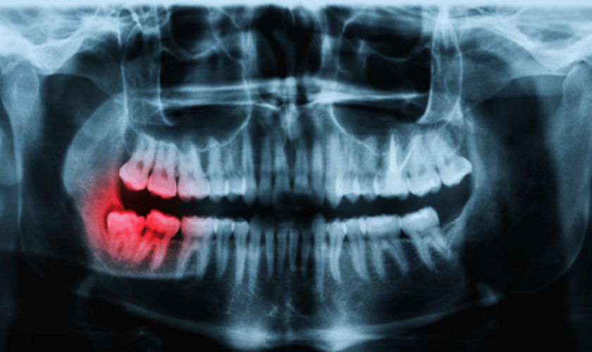 Computerised dental X-ray